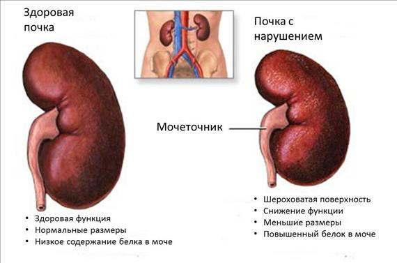 Нефропатия